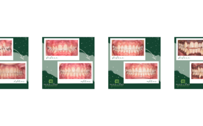 Invisalign® from Parkland Orthodontics