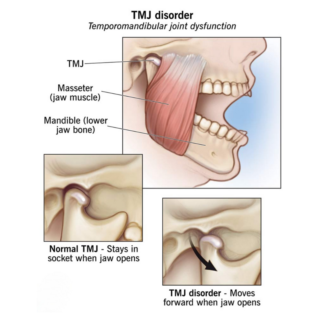TMJ Disorder